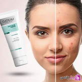 کرم بیوممتیک ژلی آنتی آکنه ضدجوش و ضدلک ۴۰ میل برند گاتیو ایتالیا
